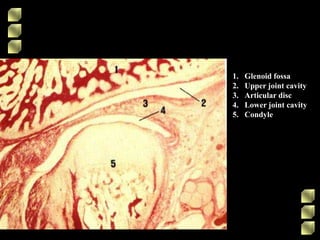 1. Glenoid fossa
2. Upper joint cavity
3. Articular disc
4. Lower joint cavity
5. Condyle
 