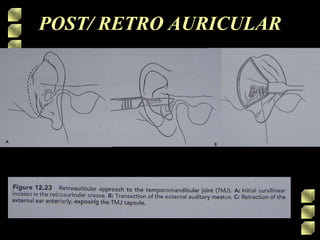POST/ RETRO AURICULAR
 