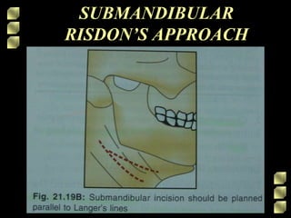 SUBMANDIBULAR
RISDON’S APPROACH
 