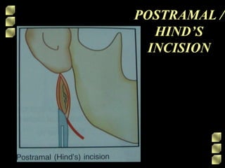 POSTRAMAL /
HIND’S
INCISION
 