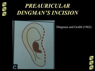 PREAURICULAR
DINGMAN’S INCISION
Dingman and Grabb (1962)
 