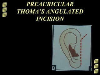 PREAURICULAR
THOMA’S ANGULATED
INCISION
 