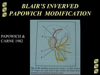 BLAIR’S INVERVED
PAPOWICH MODIFICATION
PAPOWICH &
CARNE 1982
 
