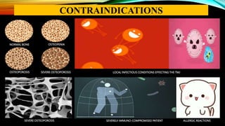NORMAL BONE
NORMAL BONE OSTEOPENIA
NORMAL BONE OSTEOPENIA
LOCAL INFECTIOUS CONDITIONS EFFECTING THE TMJ
SEVERELY IMMUNO-COMPROMISED PATIENT ALLERGIC REACTIONS
CONTRAINDICATIONS
OSTEOPOROSIS SEVERE OSTEOPOROSIS
SEVERE OSTEOPOROSIS
 