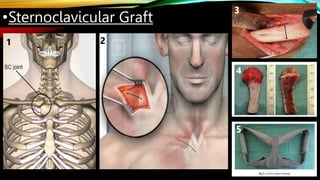 •Sternoclavicular Graft
1 2
3
4
5
 