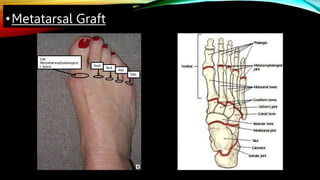 •Metatarsal Graft
D
 