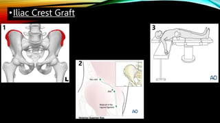 •Iliac Crest Graft
1
*
2
*Anterior Superior Iliac
Spine
*
3
L
 
