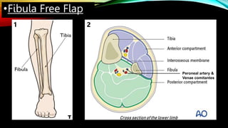 •Fibula Free Flap
1 2
Peroneal artery &
Venae comitantes
Cross section of the lower limb
T
 