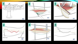 4
2
3 5
1
6
Fibular head Lateral malleolus
2 cm
 