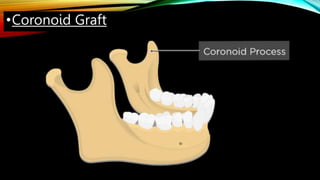 •Coronoid Graft
 