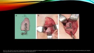 Liu Y, Li J, Hu J, Zhu S, Luo E, Hsu Y. Autogenous coronoid process pedicled on temporal muscle grafts for reconstruction of the mandible condylar in patients with temporomandibular joint ankylosis.
Oral Surg Oral Med Oral Pathol Oral Radiol Endod. 2010 Feb;109(2):203-10
 