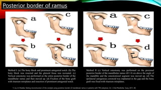 Method I. (a) The bony block and prominent antegonial notch. (b) The
bony block was resected and the glenoid fossa was recreated. (c)
Vertical osteotomy was performed on the entire posterior border of the
mandibular ramus and then moved up. (d) Fixation of the bone graft
with titanium miniplates and resection of prominent antegonial notch.
Method II (c) Vertical osteotomy was performed on the proximal
posterior border of the mandibular ramus till 1.0 cm above the angle of
the mandible and the osteotomized segment was moved up. (d) The
ipsilateral autogenous coronoid was implanted in the gap and the bony
graft was fixed with titanium miniplates.
Y. Liu, A. Khadka: Sliding reconstruction of the condyle using posterior border of mandibular ramus in patients with TMJ ankylosis. Int. J. Oral Maxillofac. Surg. 2011; 40.
Posterior border of ramus
 