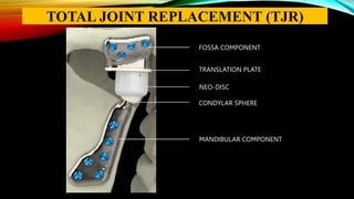 FOSSA COMPONENT
TRANSLATION PLATE
NEO-DISC
CONDYLAR SPHERE
MANDIBULAR COMPONENT
TOTAL JOINT REPLACEMENT (TJR)
 