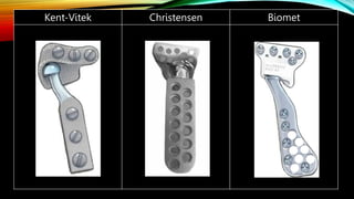 Kent-Vitek Christensen Biomet
 