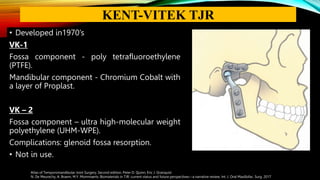• Developed in1970’s
VK-1
Fossa component - poly tetrafluoroethylene
(PTFE).
Mandibular component - Chromium Cobalt with
a layer of Proplast.
VK – 2
Fossa component – ultra high-molecular weight
polyethylene (UHM-WPE).
Complications: glenoid fossa resorption.
• Not in use.
Atlas of Temporomandibular Joint Surgery, Second edition, Peter D. Quinn, Eric J. Granquist
N. De Meurechy, A. Braem, M.Y. Mommaerts: Biomaterials in TJR: current status and future perspectives—a narrative review. Int. J. Oral Maxillofac. Surg. 2017
KENT-VITEK TJR
 