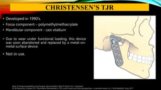 • Developed in 1990’s.
• Fossa component – polymethylmethacrylate
• Mandibular component - cast vitallium
• Due to wear under functional loading, this device
was soon abandoned and replaced by a metal-on-
metal surface device.
• Not in use.
Atlas of Temporomandibular Joint Surgery, Second edition, Peter D. Quinn, Eric J. Granquist
N. De Meurechy, A. Braem, M.Y. Mommaerts: Biomaterials in TJR: current status and future perspectives—a narrative review. Int. J. Oral Maxillofac. Surg. 2017
CHRISTENSEN’S TJR
 