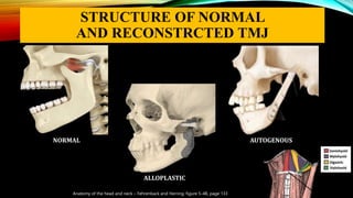 STRUCTURE OF NORMAL
AND RECONSTRCTED TMJ
Anatomy of the head and neck – Fehrenback and Herring, figure 5-4B, page 133
NORMAL
ALLOPLASTIC
AUTOGENOUS
 