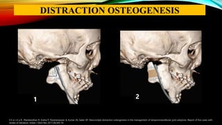 S h a r m a R , Manikandhan R, Sneha P, Parameswaran A, Kumar JN, Sailer HF. Neocondyle distraction osteogenesis in the management of temporomandibular joint ankylosis: Report of five cases with
review of literature. Indian J Dent Res 2017;28:269-74.
1 2
DISTRACTION OSTEOGENESIS
 