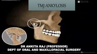 TMJ ANKYLOSIS
DR ANKITA RAJ (PROFESSOR)
DEPT OF ORAL AND MAXILLOFACIAL SURGERY
 