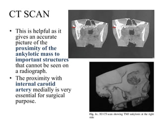 CT SCAN
• This is helpful as it
gives an accurate
picture of the
proximity of the
ankylotic mass to
important structures
that cannot be seen on
a radiograph.
• The proximity with
internal carotid
artery medially is very
essential for surgical
purpose.
 
