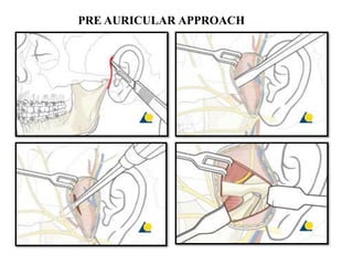 PRE AURICULAR APPROACH
 