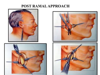 POST RAMALAPPROACH
 