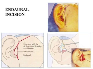 ENDAURAL
INCISION
 