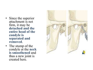 • Since the superior
attachment is not
firm, it may be
detached and the
entire head of the
condyle is
separated and
removed.
• The stump of the
condyle at the neck
is smoothened and
thus a new joint is
created here.
 