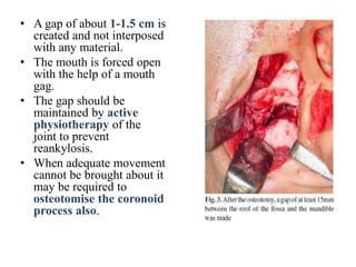 • A gap of about 1-1.5 cm is
created and not interposed
with any material.
• The mouth is forced open
with the help of a mouth
gag.
• The gap should be
maintained by active
physiotherapy of the
joint to prevent
reankylosis.
• When adequate movement
cannot be brought about it
may be required to
osteotomise the coronoid
process also.
 