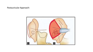 Postauricular Injection TMJ Ankylosis & It's Management | PPTX