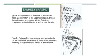 SAWHNEY GRADING
Type I: Condylar head is flattened or deformed in
close approximation to the upper joint space. Dense
fibro-adhesions are present within. Restricted
movements is due to fibrosis in and around the joint.
Type II: Flattened condyle in close approximation to
the glenoid fossa, bony fusion of the articular surfaces
anteriorly or posteriorly and limited to a small area.
 