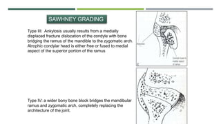 Type III: Ankylosis usually results from a medially
displaced fracture dislocation of the condyle with bone
bridging the ramus of the mandible to the zygomatic arch.
Atrophic condylar head is either free or fused to medial
aspect of the superior portion of the ramus
Type IV: a wider bony bone block bridges the mandibular
ramus and zygomatic arch, completely replacing the
architecture of the joint.
SAWHNEY GRADING
 