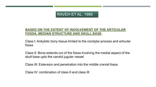 RAVEH ET AL. 1989
BASED ON THE EXTENT OF INVOLVEMENT OF THE ARTICULAR
FOSSA, MEDIAN STRUCTURE AND SKULL BASE.
Class I: Ankylotic bony tissue limited to the condylar process and articular
fossa
Class II: Bone extends out of the fossa involving the medial aspect of the
skull base upto the carotid jugular vessel
Class III: Extension and penetration into the middle cranial fossa
Class IV: combination of class II and class III
 