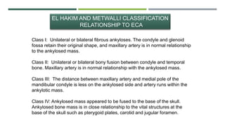 EL HAKIM AND METWALLI CLASSIFICATION
RELATIONSHIP TO ECA
Class I: Unilateral or bilateral fibrous ankyloses. The condyle and glenoid
fossa retain their original shape, and maxillary artery is in normal relationship
to the ankylosed mass.
Class II: Unilateral or bilateral bony fusion between condyle and temporal
bone. Maxillary artery is in normal relationship with the ankylosed mass.
Class III: The distance between maxillary artery and medial pole of the
mandibular condyle is less on the ankylosed side and artery runs within the
ankylotic mass.
Class IV: Ankylosed mass appeared to be fused to the base of the skull.
Ankylosed bone mass is in close relationship to the vital structures at the
base of the skull such as pterygoid plates, carotid and jugular foramen.
 