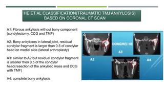 HE ET AL CLASSIFICATION(TRAUMATIC TMJ ANKYLOSIS)
BASED ON CORONAL CT SCAN
A1: Fibrous ankylosis without bony component
(condylectomy, CCG and TMF)
A2: Bony ankyloses in lateral joint, residual
condylar fragment is larger than 0.5 of condylar
head on medial side (lateral arthroplasty)
A3: similar to A2 but residual condylar fragment
is smaller then 0.5 of the condylar
head(resection of the ankylotic mass and CCG
with TMF)
A4: complete bony ankylosis
 