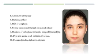 5. Asymmetry of the face
6. Flattening of face
7. Shift of symphysis
8. Normal occlusion of the teeth on uninvolved side
9. Shortness of vertical and horizontal ramus of the mandible.
10. Deep ante-gonial notch on the involved side.
11. Decreased or almost absent joint space
 