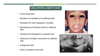 UNILATERAL ANKYLOSIS
• Facial asymmetry
• Deviation of mandible to the affected side
• Receded chin with hypoplastic mandible
• Roundness and fullness of face on affected
side
• Flatness and elongation on opposite side
• Absence of condylar movements on affected
side
• Antegonial notch
• Class II, posterior cross bite
 
