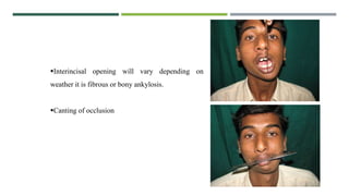 Interincisal opening will vary depending on
weather it is fibrous or bony ankylosis.
Canting of occlusion
 