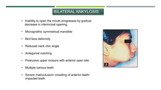 BILATERAL ANKYLOSIS
• Inability to open the mouth progresses by gradual
decrease in interincisal opening.
• Micrognathic symmetrical mandible
• Bird face deformity
• Reduced neck chin angle
• Antegonial notching
• Protrusive upper incisors with anterior open bite
• Multiple carious teeth
• Severe malocclusion/ crowding of anterior teeth/
impacted teeth
 