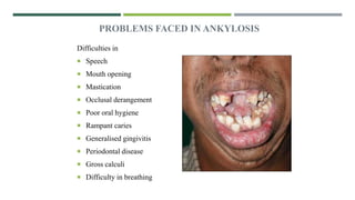 PROBLEMS FACED IN ANKYLOSIS
Difficulties in
 Speech
 Mouth opening
 Mastication
 Occlusal derangement
 Poor oral hygiene
 Rampant caries
 Generalised gingivitis
 Periodontal disease
 Gross calculi
 Difficulty in breathing
 