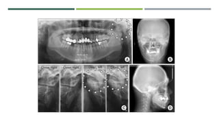 LATERAL TOMOGRAPHIC SECTION
 