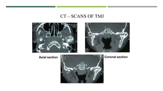 CT – SCANS OF TMJ
Coronal section
Axial section
 