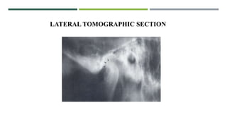 LATERAL TOMOGRAPHIC SECTION
 