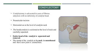 • Condylectomy is advocated in cases of fibrous
ankylosis with no deformity of condylar head.
• Preauricular incision
• Horizontal cut at the level of condylar neck
• The head(condyle) is sectioned at the level of neck and
carefully separated.
CONDYLECTOMY
• Entire head of the condyle is separated and
removed.
• The stump of the condyle at the neck is smoothened
and thus a new joint is created here.
 