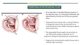 • If an intact disc is identified during resection of
the ankylotic mass, it is dissected, mobilized, and
repositioned to line the roof of the new glenoid
fossa.
• Temporalis fascia along with a varying thickness
of temporalis muscle may be harvested as an
axial flap based on the middle and deep temporal
arteries and veins.
• The dependable blood supply, the proximity to
the TMJ and the ability to alter the arc of
rotation by basing the flap inferiorly or posteriorly
• Supports the reconstructed condyle/ramus unit to
maintain flap vascularity
TEMPORALIS MYOFASCIAL FLAP
 
