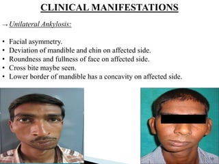 CLINICAL MANIFESTATIONS
→ Unilateral Ankylosis:
• Facial asymmetry.
• Deviation of mandible and chin on affected side.
• Roundness and fullness of face on affected side.
• Cross bite maybe seen.
• Lower border of mandible has a concavity on affected side.
10
 
