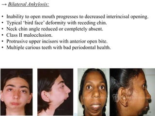 → Bilateral Ankylosis:
• Inability to open mouth progresses to decreased interincisal opening.
• Typical ‘bird face’ deformity with receding chin.
• Neck chin angle reduced or completely absent.
• Class II malocclusion.
• Protrusive upper incisors with anterior open bite.
• Multiple carious teeth with bad periodontal health.
11
 