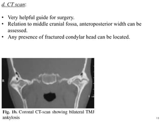 13
d. CT scan:
• Very helpful guide for surgery.
• Relation to middle cranial fossa, anteroposterior width can be
assessed.
• Any presence of fractured condylar head can be located.
 