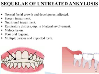 SEQUELAE OF UNTREATED ANKYLOSIS
 Normal facial growth and development affected.
 Speech impairment.
 Nutritional impairment.
 Respiratory distress, esp. in bilateral involvement.
 Malocclusion.
 Poor oral hygiene.
 Multiple carious and impacted teeth.
14
 