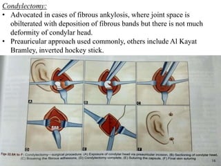 Condylectomy:
• Advocated in cases of fibrous ankylosis, where joint space is
obilterated with deposition of fibrous bands but there is not much
deformity of condylar head.
• Preauricular approach used commonly, others include Al Kayat
Bramley, inverted hockey stick.
16
 